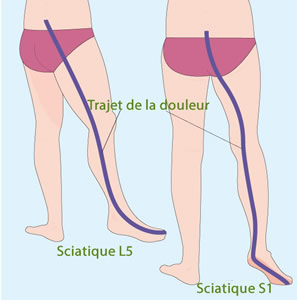 ceinture airlomb sciatique
