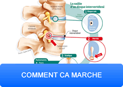 fonctionnement ceinture lombaire gonflable AirLOMB