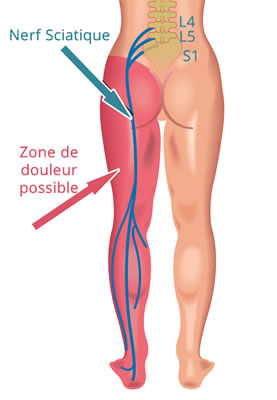 zone de douleur sciatique possible