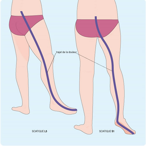 nerf sciatique pincé en L5