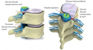 hernie-discale