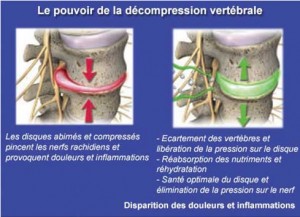 Le pouvoir de la compression vertébrale contre le mal de dos