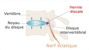 Le mal de dos créé par la compression du disque vertébral sur le nerf sciatique