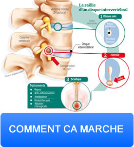 les disques intervertébraux